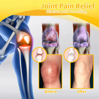 🇨🇦Official Store: flysmus™ Bee-Venom Pain-Relief Bone Healing Cream👨‍⚕️Healthy Canada Approved