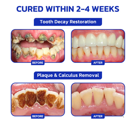 🇨🇦🦷🦷 Furzero™ Focussmile Bee Venom Treatment Oral Powder